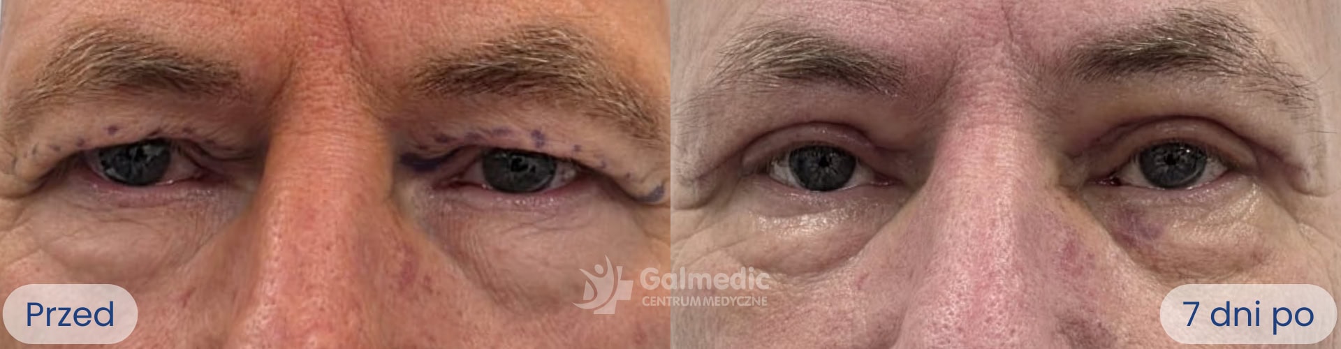 plastyka powiek górnych