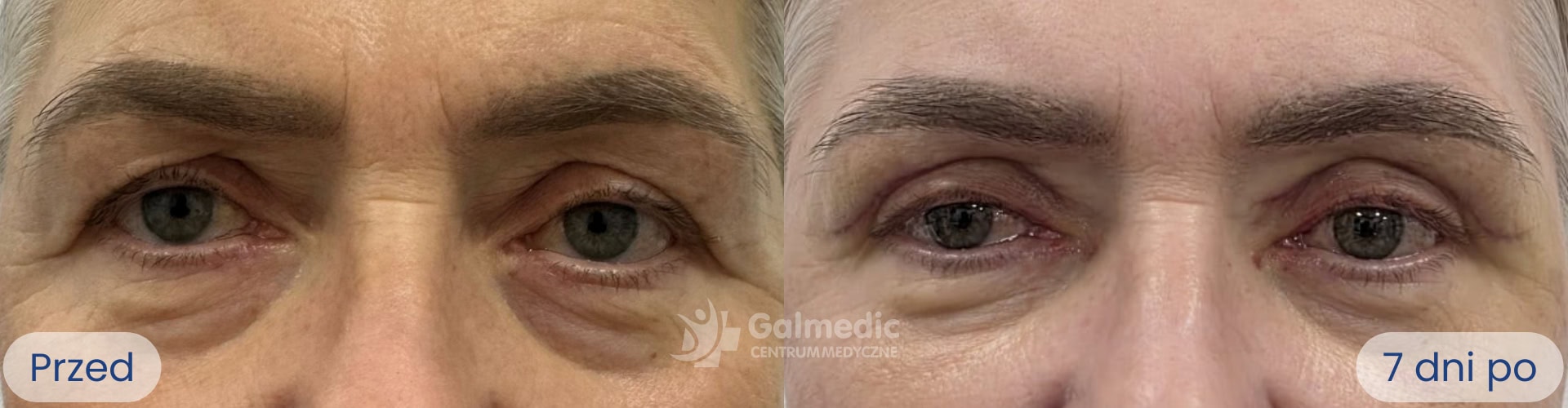 plastyka powiek górnych