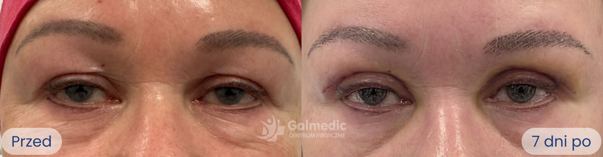 plastyka powiek górnych