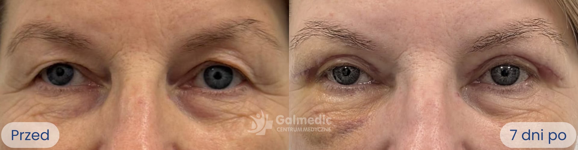 plastyka powiek górnych