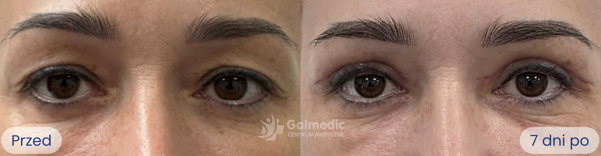 plastyka powiek górnych